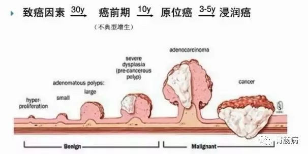 體檢查出腸息肉一定要切除！ 95%腸癌由它演變而來