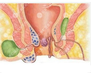 南寧哪個醫(yī)院可以做肛周膿腫？
